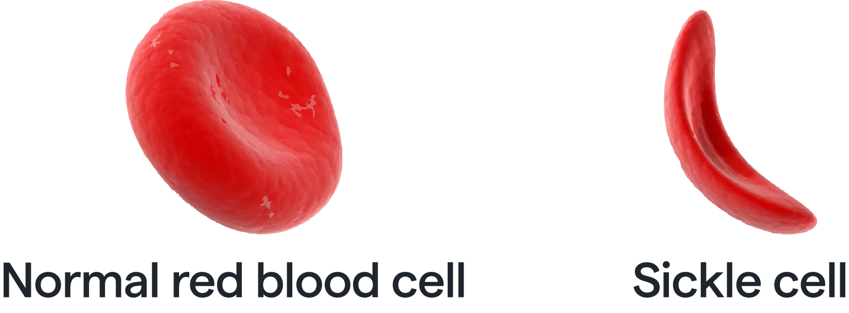 The Potential of AI in Sickle Cell Disease RedBrick AI Blog